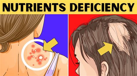 8 Signs Your Body Is Deficient In Nutrients Youtube