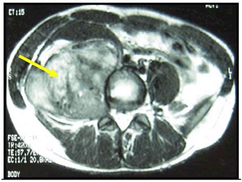 Full Text Huge Retroperitoneal Schwannoma In A Young Male