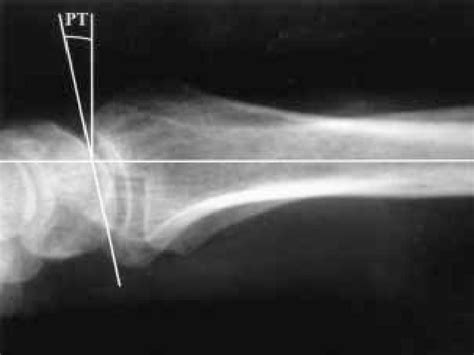 Figure 1 From The Functional Importance Of Malunion In Distal Radius