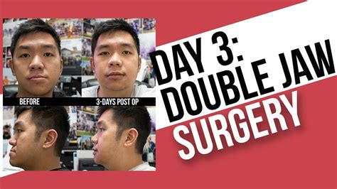 Day 3 Double Jaw Surgery Post Op Youtube