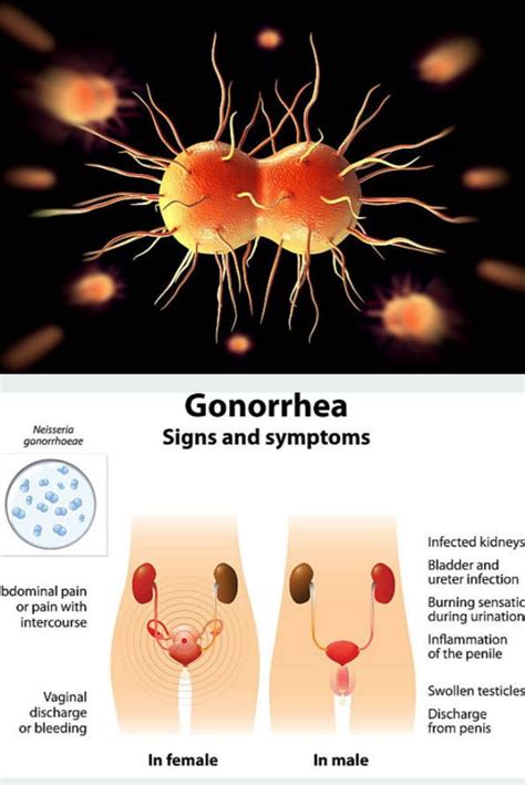 Common Is Gonorrhea Without Discharge