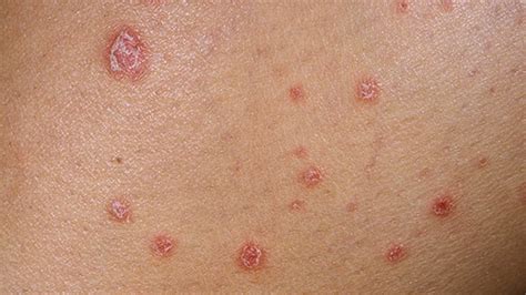 Psoriasis Symptoms Causes And Treatment Avens Blog