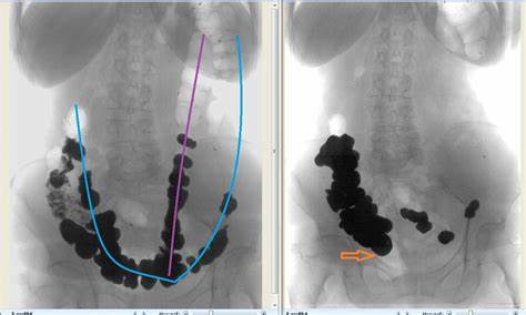Долихосигма у детей диета