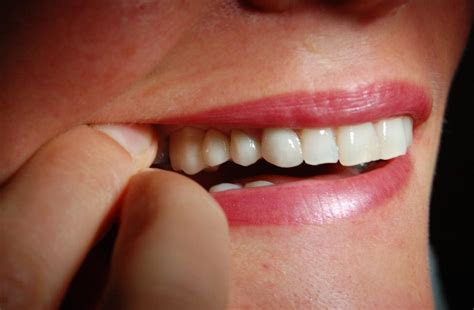 Replacing Missing Teeth With Bridges Riverside Dental Practice