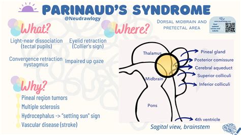 Parinauds Syndrome — Neudrawlogy Simplifying Neurology