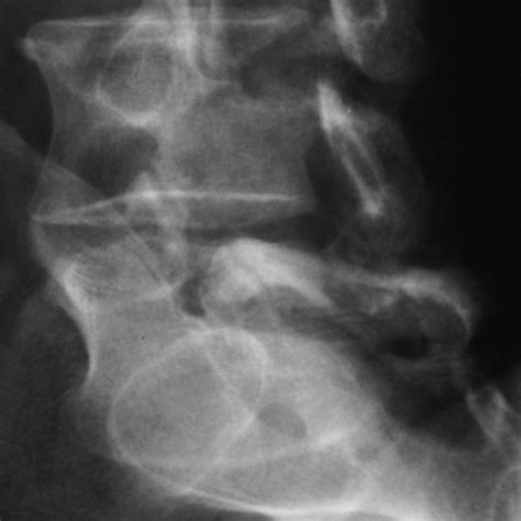 L5 pars defect | Image | Radiopaedia.org