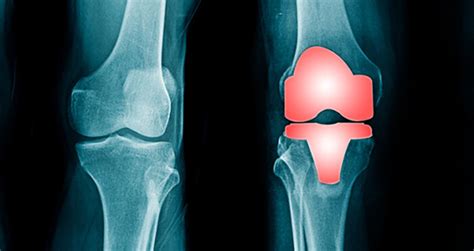 Cementless Knee Replacement Has Promising Potential To Improve Patient Care