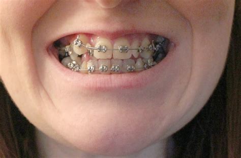 The brace lady: My first month in braces