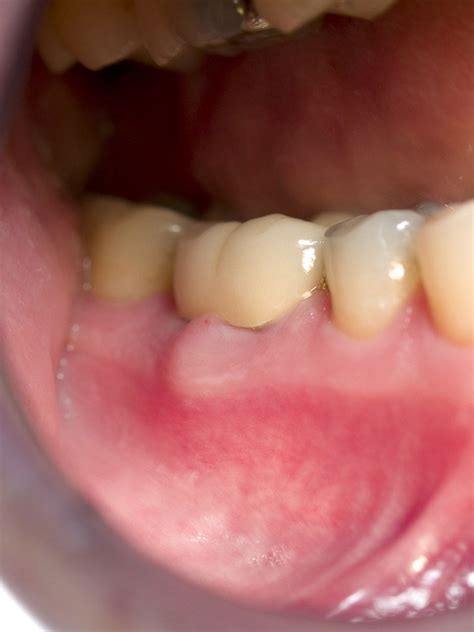 Gingival Abscess Definition Of Gingival Abscess