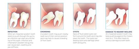 Are Your Wisdom Teeth Impacted Dentist In Monroe Nc