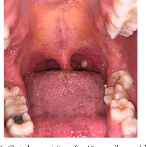 Pdf Unusual Site For A White Nodule On The Palatine Tonsil