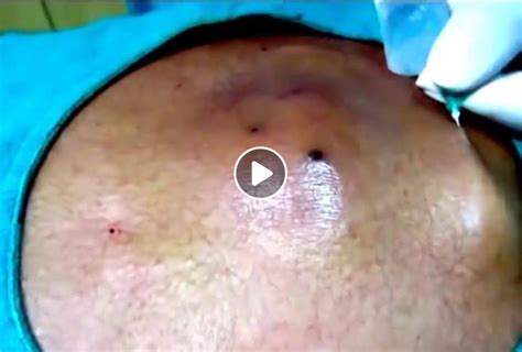 Deep Ingrown Hair Cyst Removal Viral On The Web Now