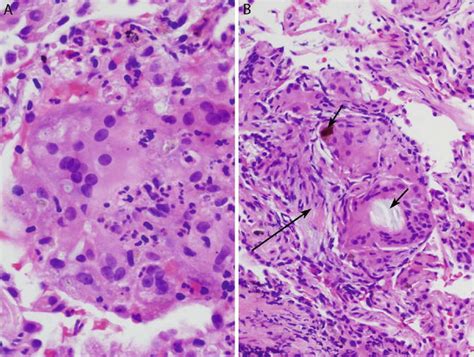 Diagnosis Of Granulomatous Disease And Vasculitis In Small Lung