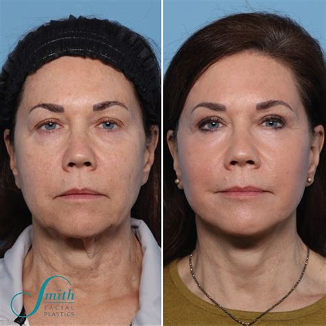 Face Lifts Before And After