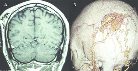 A Coronal T1 W Mri Showing The Scalp Avm On The Left Parieto Occipital