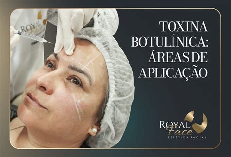 Biologo Pode Aplicar Botox