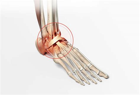 Fracture De La Malléole Du Tibia Et Du Péroné Internetemps De