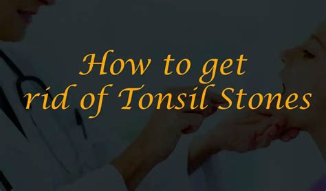Best Tonsil Stone Removal Guide 2020 Get Rid Of Tonsil Stones