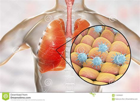 Viruses In Human Lungs Stock Illustration Illustration Of Concept