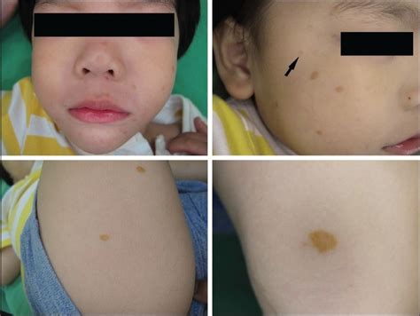 Disseminated Asymptomatic Yellowish Papules On The Face Trunk And
