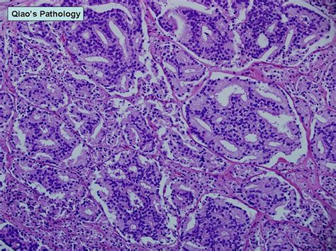 Qiaos Pathology Adenocarcinoma Of The Prostate Gleason Pattern 4