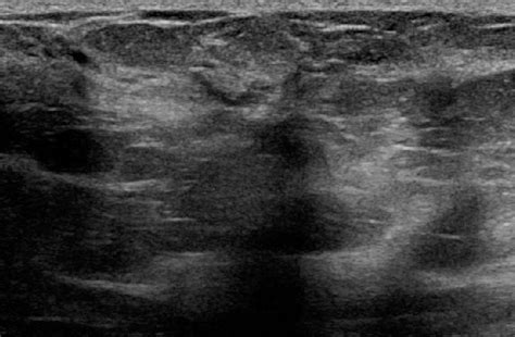 Ultrasound Image Demonstrates A Subtle Mildly Hypoechoic Mass With