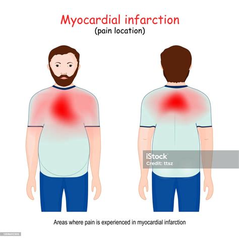 Myocardial Infarction Areas Heart Attack Pain Location Stock