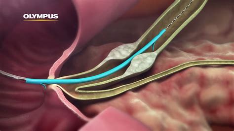 Quickplacev Biliary Stent Youtube