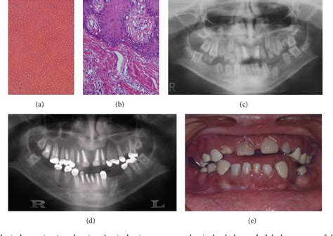 Figure 1 From Generalised Versus Regional Odontodysplasia Diagnosis
