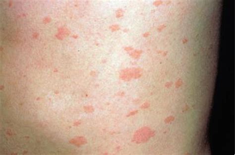 Ehrlichiosis Causes Symptoms Rash Diagnosis Treatment