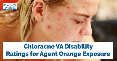 Chloracne From Agent Orange Can Earn A Va Rating And Pay Disability