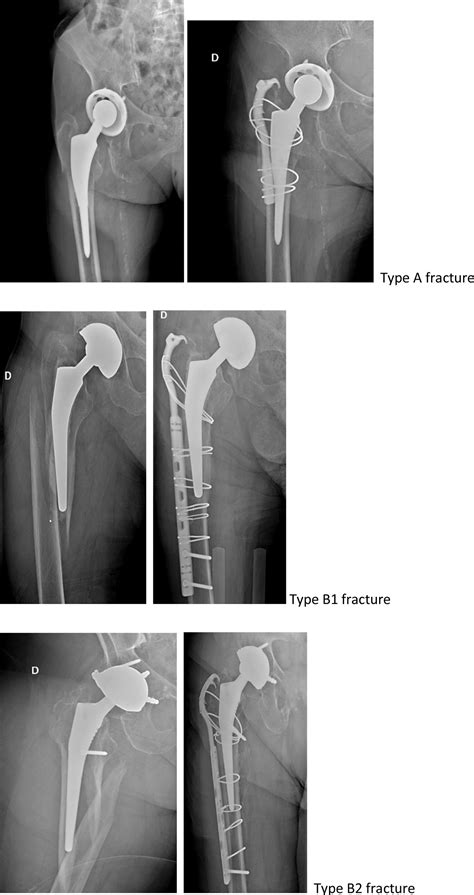Osteosynthesis Of Periprosthetic Type A And B Femoral Fractures Using