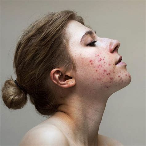 10 Inspiring Images That Prove Acne Is Not Ugly