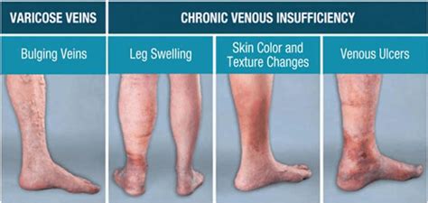 Will Vinegar Reduce Brown Coloring From Stasis Dermatitis Fleenor Havesix