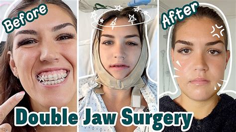 6 Days After Double Jaw Surgery Jaw Surgery Recovery Vlog Ep 4