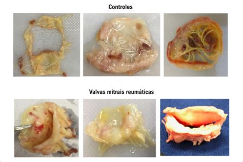Histopathological Characterization Of Mitral Valvular Lesions From