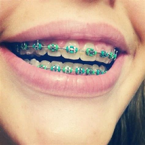 Pick Your Best One With The Help Of Braces Color Wheel Braces Colors Green Braces Braces