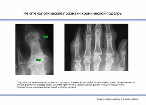 Ревматоидный артрит диета при обострении Рентген Суставов При Артрите — Buy-artox.ru Рентген Суставов При Артрите — Buy-artox.ru Ревматоидный артрит диета при обострении