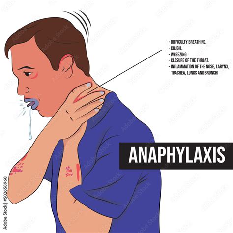Anaphylaxis An Extremely Severe Allergic Reaction That Affects The