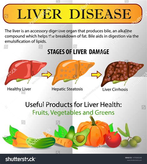 Liver Disease Infographics Healthy Foods Stock Vector Royalty Free