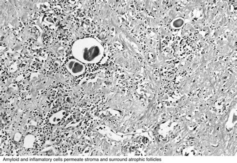 Pathology Outlines Amyloid Goiter