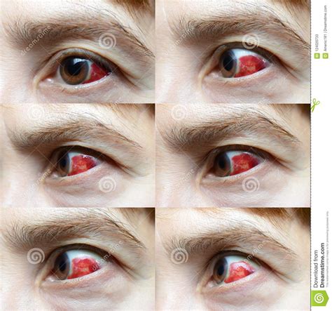 Woman With Burst Blood Vessel In Eye Stock Image Image Of Health
