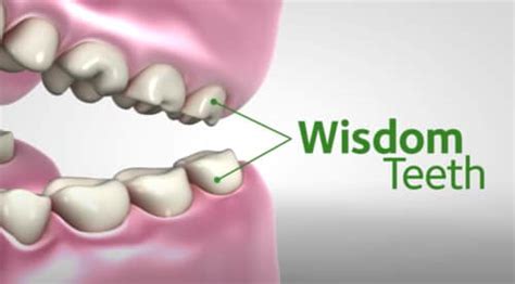 Wisdom Teeth Stitches