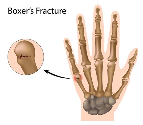 Understanding A Boxer S Fracture Of The Hand Facty Health