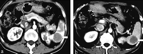 Contrast Enhanced Ct Images Revealed A Solitary Round Splenic