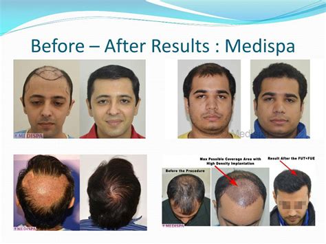 Ppt Best Hair Transplant Clinic In Dubai Powerpoint Presentation Free Download Id7763296