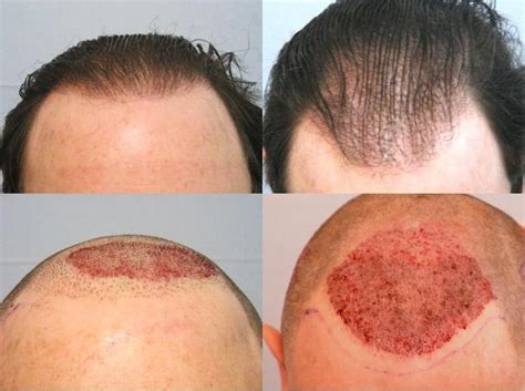 But likewise, the hair transplant cost isn't inclusive of health tourism services. Hair Transplantation Clinics: June 2013