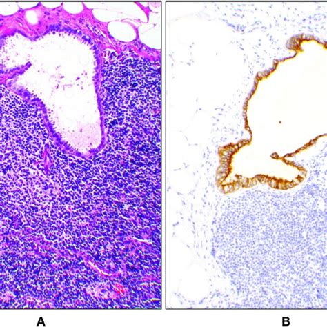 Micrometastasis A Sentinel Lymph Node With Micrometastatic Carcinoma