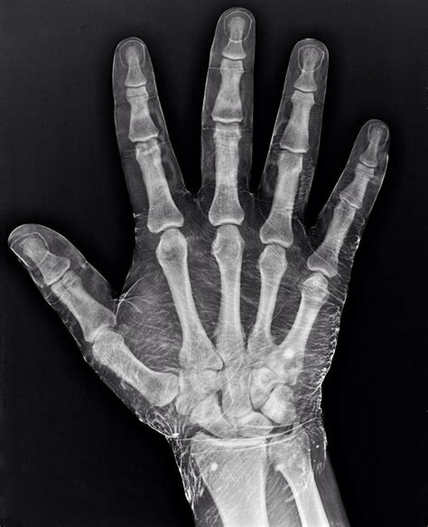 X Ray Of A Hand Dipped In Iodine Iodine Absorbs X Rays Revealing The