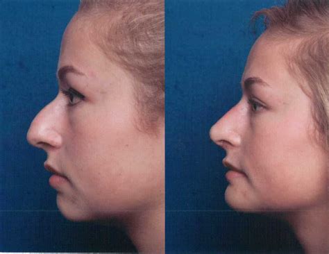 The Nose Clinic Before And After Nose Surgery Photos 48
